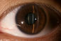 3.5» διαγνωστικός εξοπλισμός οφθαλμολογίας για το διαβήτη γλαυκώματος