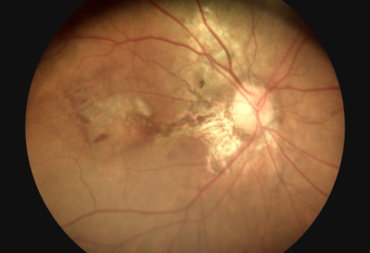 3 φακών διαθέσιμος οφθαλμικός προηγούμενος φακός ματιών καμερών επιφάνειας ματιών καμερών βυθών εξοπλισμού ψηφιακός αναπληρώσιμος