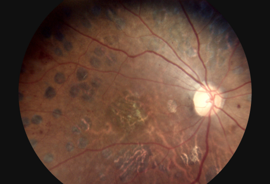 3 φακών διαθέσιμος οφθαλμικός προηγούμενος φακός ματιών καμερών επιφάνειας ματιών καμερών βυθών εξοπλισμού ψηφιακός αναπληρώσιμος