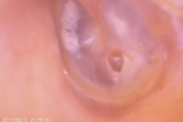Τηλεοπτικό ψηφιακό ωτοσκόπιο amera αυτιών και μύτης Γ για τη διάτρηση της τυμπανικής μεμβράνης