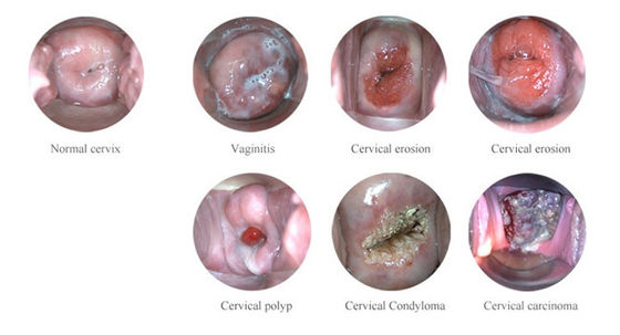 Φορητό Ψηφιακό Ηλεκτρονικό Κολποσκόπιο