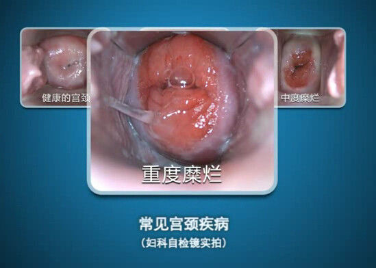 Το ψηφιακό ενδοσκόπιο μόνος-επιθεωρεί Colposcope μίνι Colposcopy με τη σειρά της παρατήρησης 70~100mm