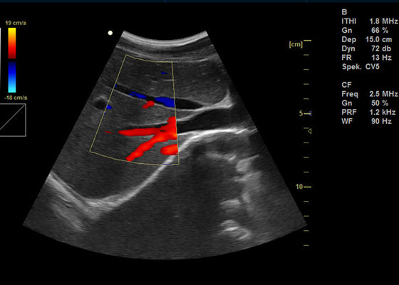15 ίντσας πλήρης ψηφιακός χρώματος Doppler υπέρηχος απεικόνισης Doppler μηχανών φορητός με το λιμένα 2 USB