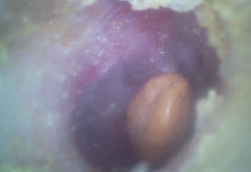 Φορητό ΩΤΟΡΙΝΟΛΑΡΥΓΓΟΛΟΓΙΚΟ οικονομικό φορητό ψηφιακό τηλεοπτικό ωτοσκόπιο πεδίου με την κάρτα λάμψης μικροϋπολογιστών SD 32G