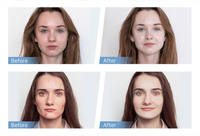 Ηλεκτρική πένα για μικροελέγγια για αναγέννηση κολλαγόνου 4